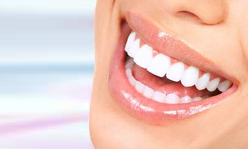 How Much Does Teeth Whitening Cost