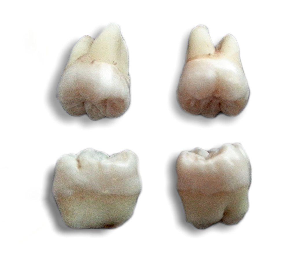 what to expect after wisdom tooth removal