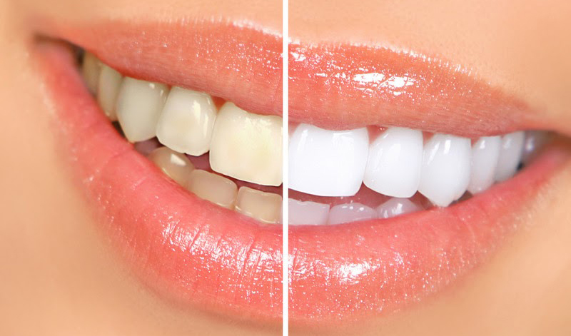 teeth veneers