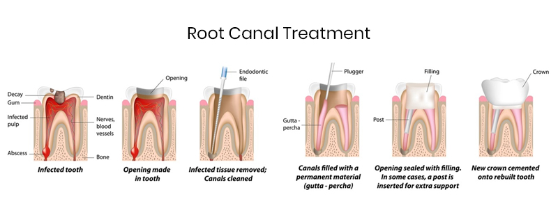 root canal treatment