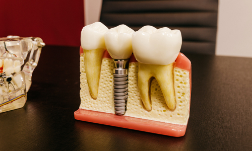 Truth About Dental Implants