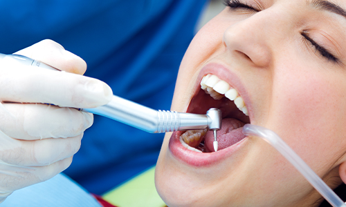 Five Signs You Need a Root Canal