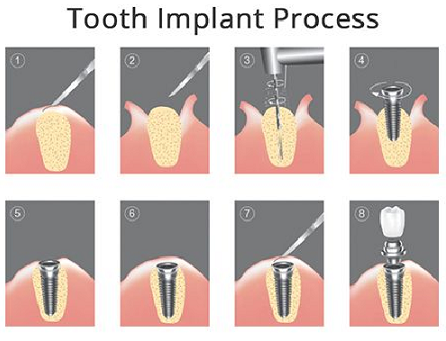 do getting dental implants hurt  	

