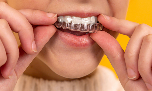 Benefits of Dental Mouthguards
