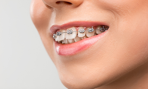 How to Speed up Orthodontic Treatment