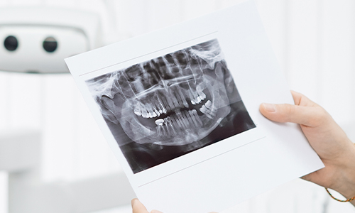 dental bone resorption