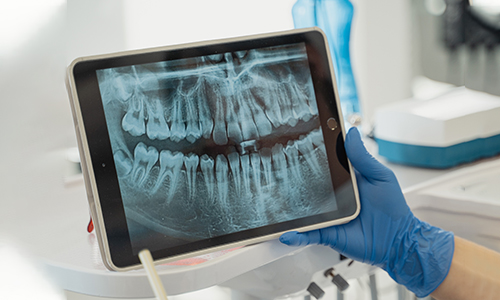 Are dental X Rays safe