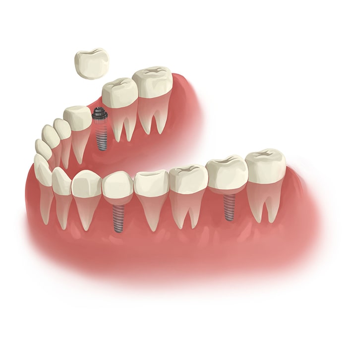 Wisdom Teeth Removed