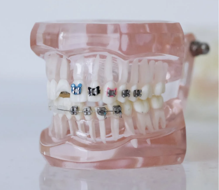 Do Braces Change Your Face Shape? First Point Dental