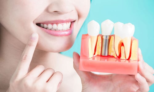 Navigating the Average Cost of Dental Implants