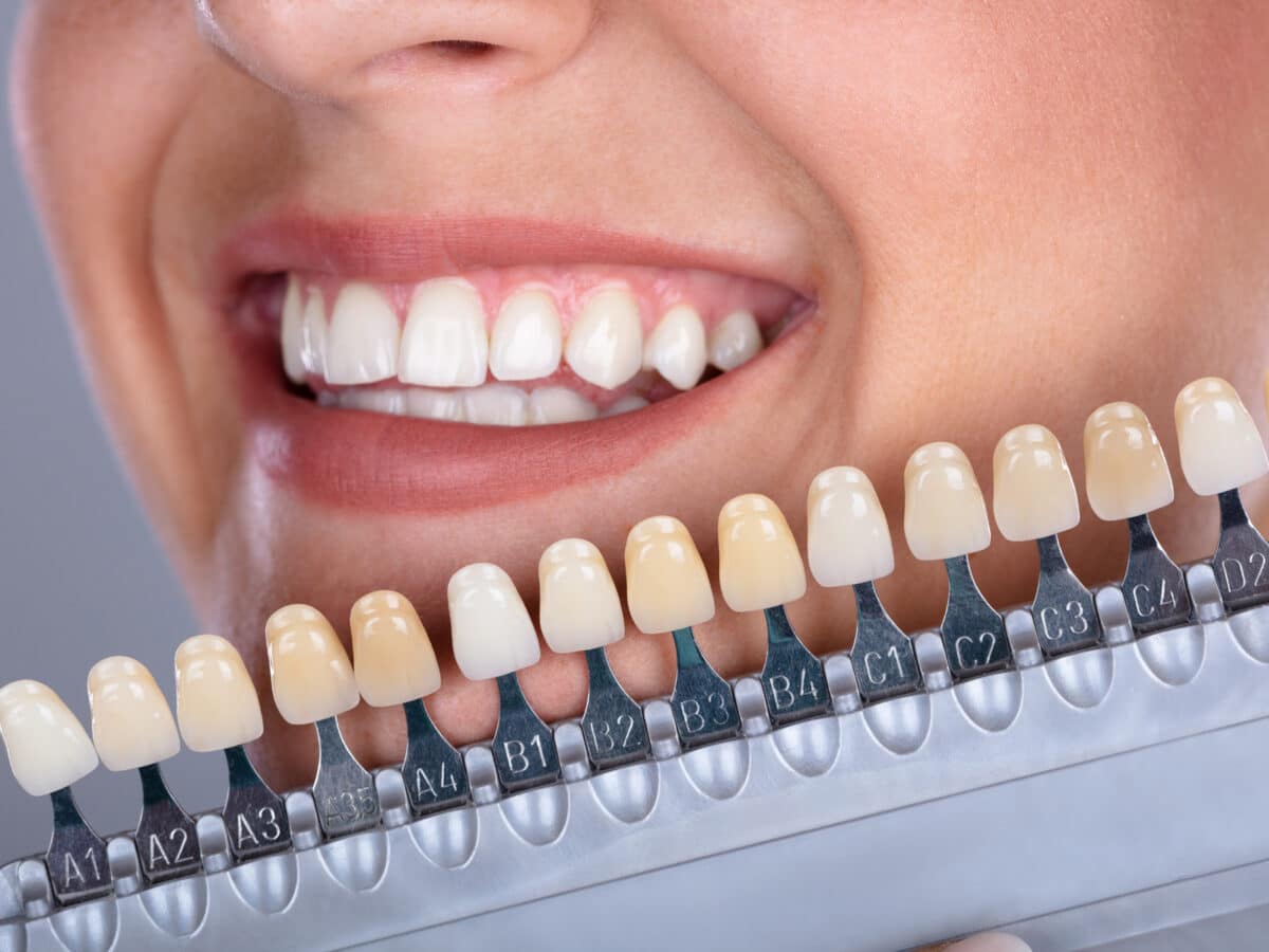 Most Common Types of Veneers