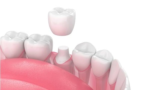 Address Toothache Caused by Dental Crowns