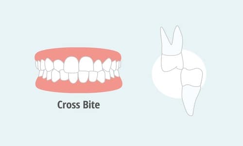 Why Does a Crossbite Need to be Fixed