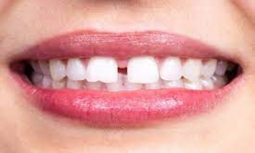 Best Ways To Fix Gaps In Your Teeth