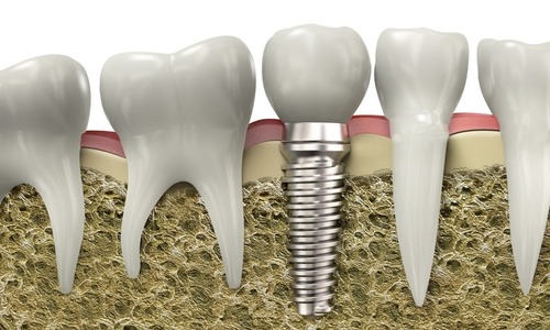 How Long Do Dental Implants Last
