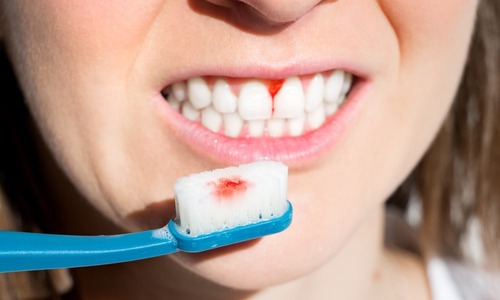 how to deal with pyorrhea